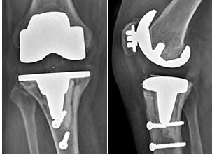 Descellement tibial et fémoral d’une prothèse totale du genou