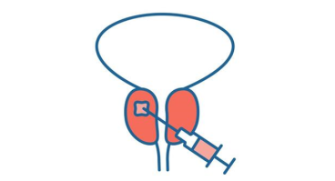 Biopsie prostate